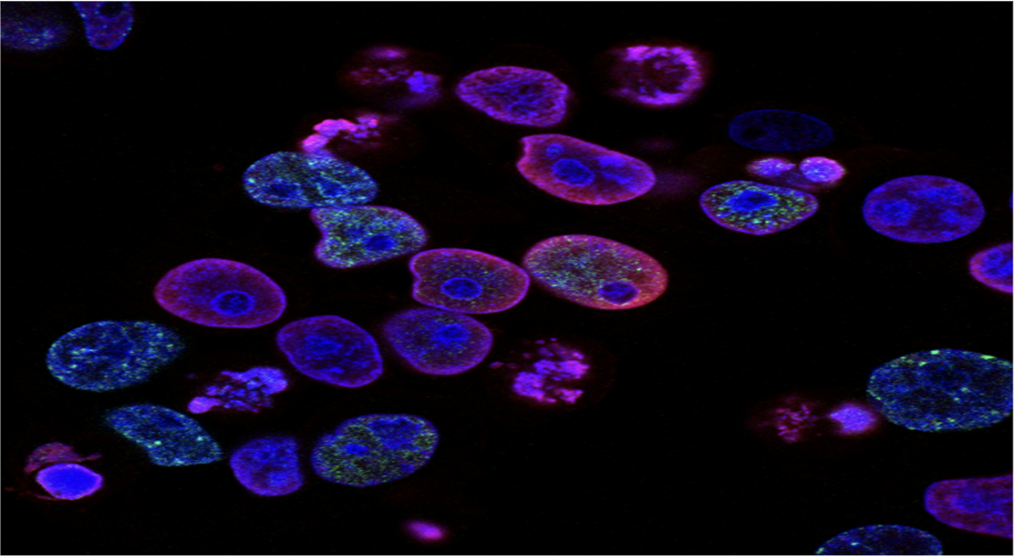 Potential Breakthrough in Metastatic Prostate Cancer Treatment Emerges